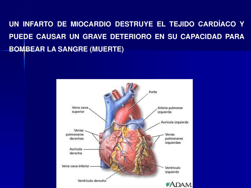 UN INFARTO DE MIOCARDIO DESTRUYE EL TEJIDO CARDÍACO Y PUEDE CAUSAR UN GRAVE DETERIORO EN SU CAPACIDAD PARA BOMBEAR LA SANGRE (MUERTE)