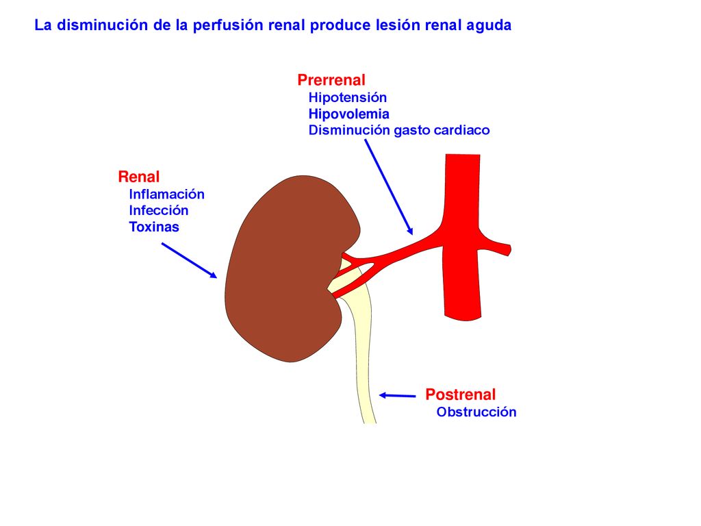 La disminución de la perfusión renal produce lesión renal aguda