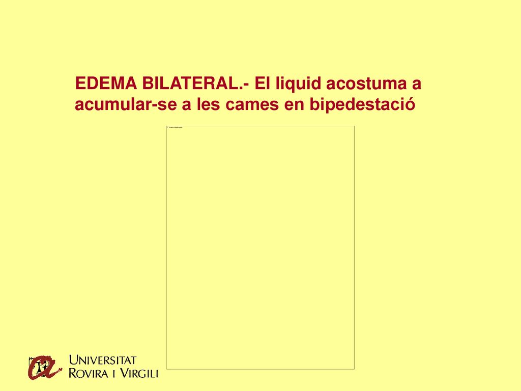 EDEMA BILATERAL.- El liquid acostuma a acumular-se a les cames en bipedestació