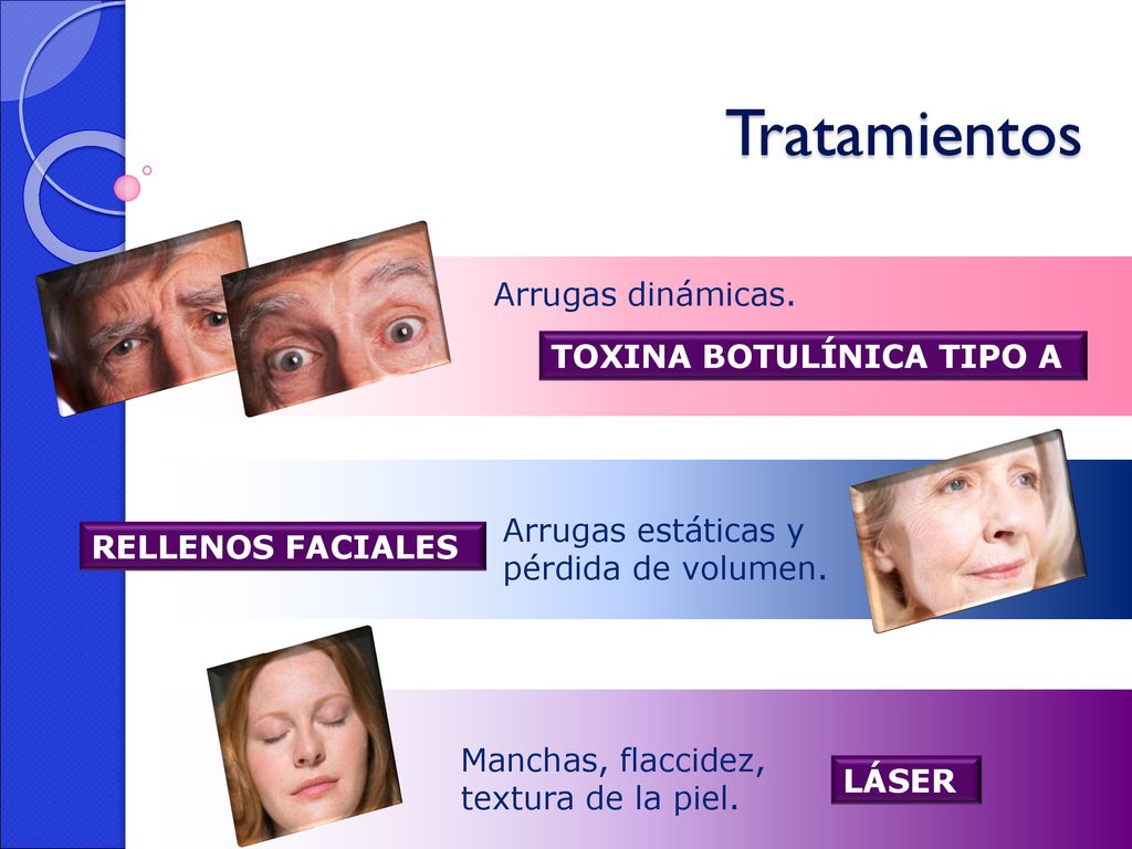 Tratamientos Arrugas dinámicas. TOXINA BOTULÍNICA TIPO A