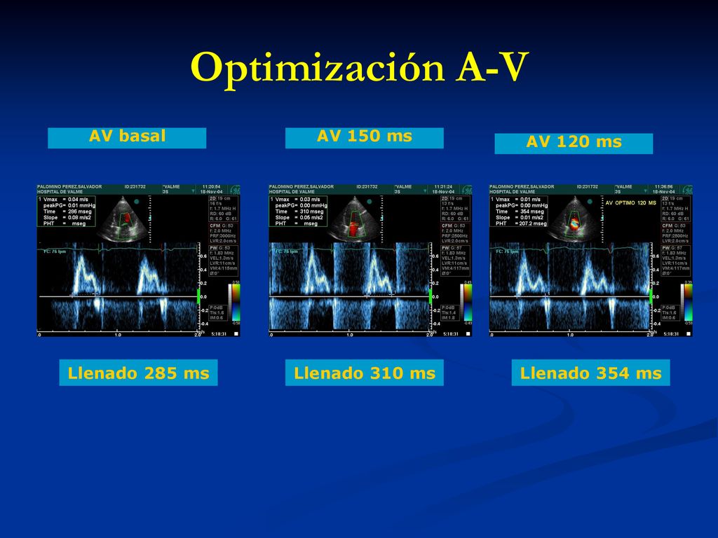 Optimización A-V AV basal AV 150 ms AV 120 ms Llenado 285 ms