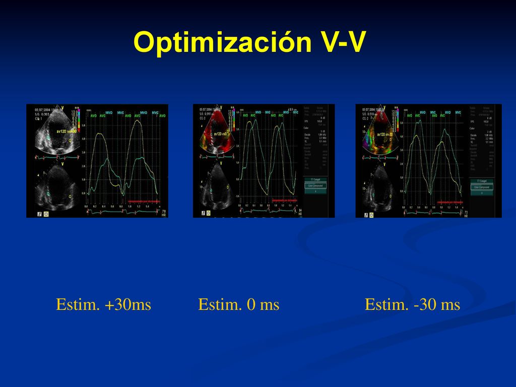 Optimización V-V Estim. +30ms Estim. 0 ms Estim. -30 ms