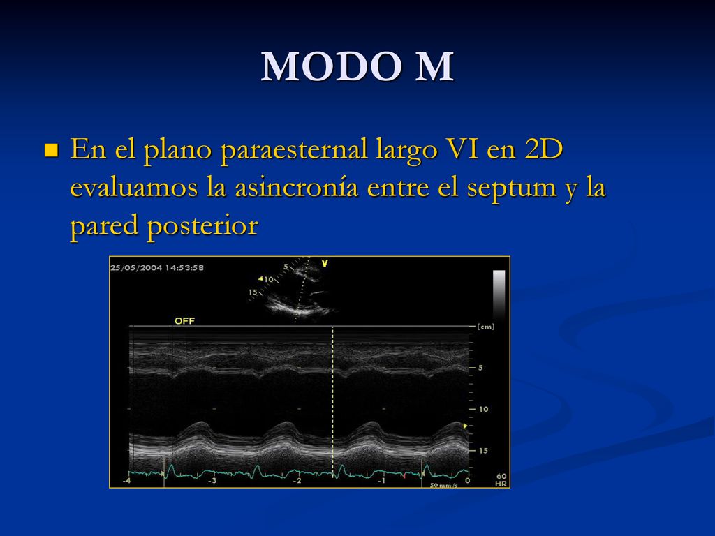 MODO M En el plano paraesternal largo VI en 2D evaluamos la asincronía entre el septum y la pared posterior.