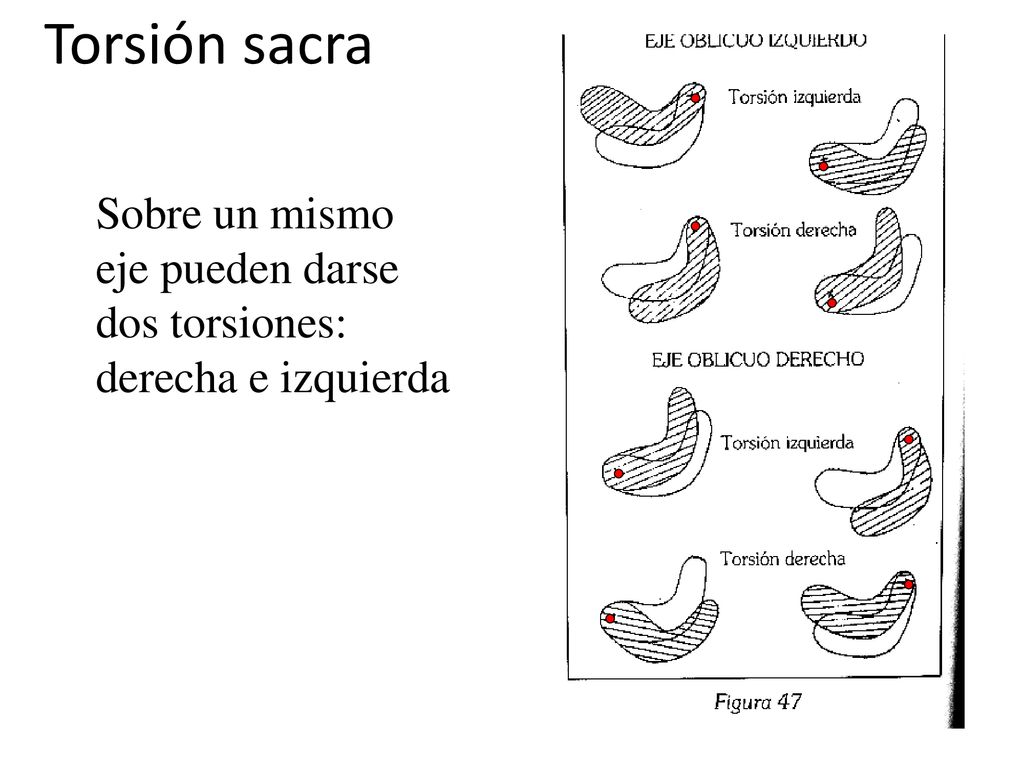 Torsión sacra Sobre un mismo eje pueden darse dos torsiones: derecha e izquierda