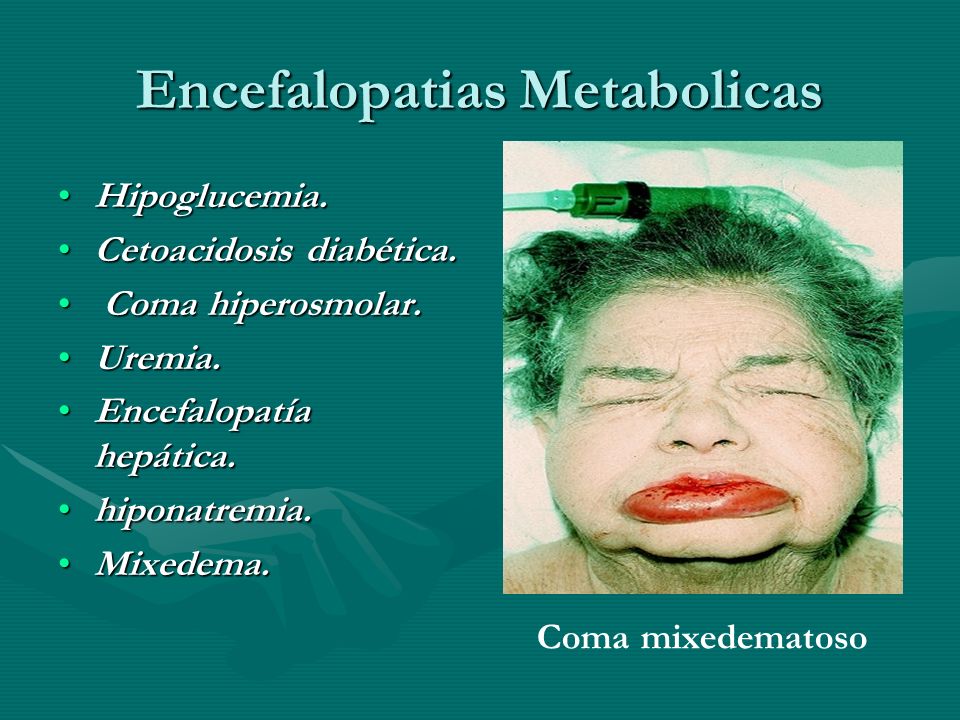Encefalopatias Metabolicas