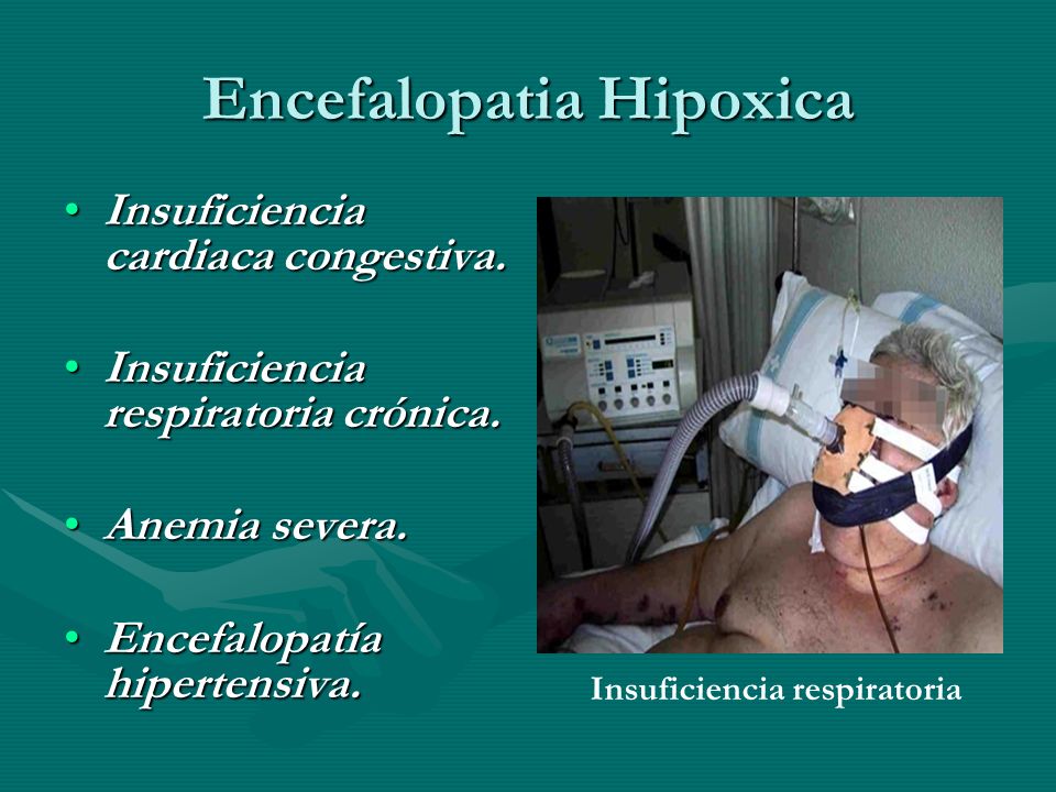 Encefalopatia Hipoxica