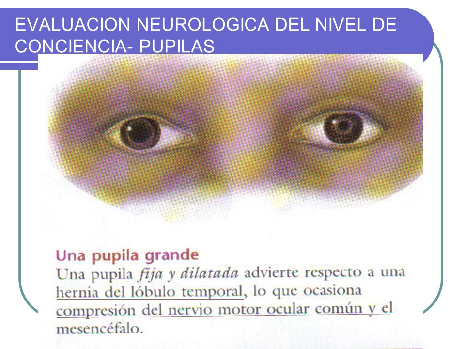 EVALUACION NEUROLOGICA DEL NIVEL DE CONCIENCIA- PUPILAS