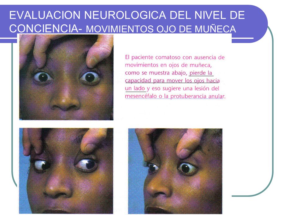 EVALUACION NEUROLOGICA DEL NIVEL DE CONCIENCIA- MOVIMIENTOS OJO DE MUÑECA