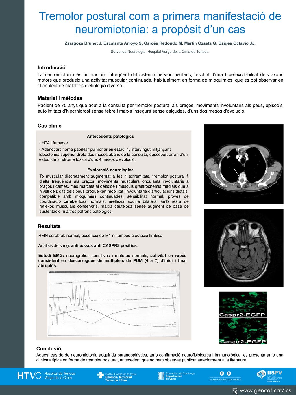 Tremolor postural com a primera manifestació de neuromiotonia: a propòsit d’un cas