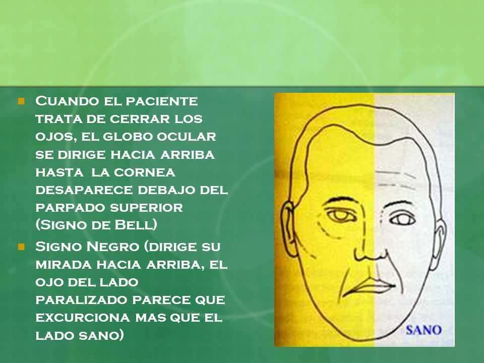 Cuando el paciente trata de cerrar los ojos, el globo ocular se dirige hacia arriba hasta la cornea desaparece debajo del parpado superior (Signo de Bell)