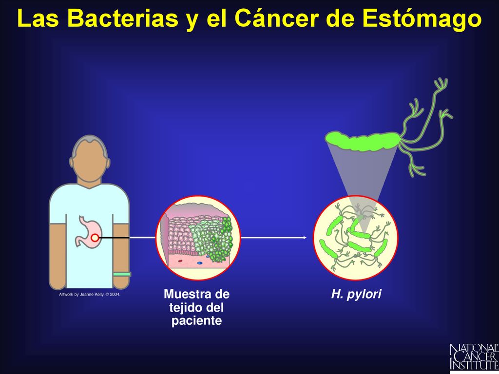 Las Bacterias y el Cáncer de Estómago Muestra de tejido del paciente