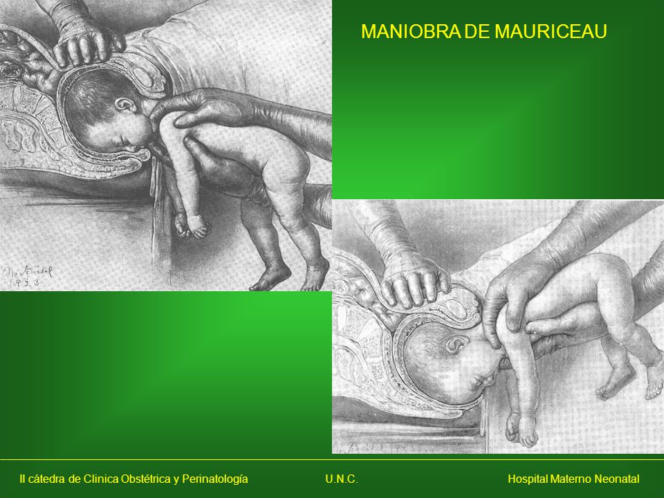 MANIOBRA DE MAURICEAU