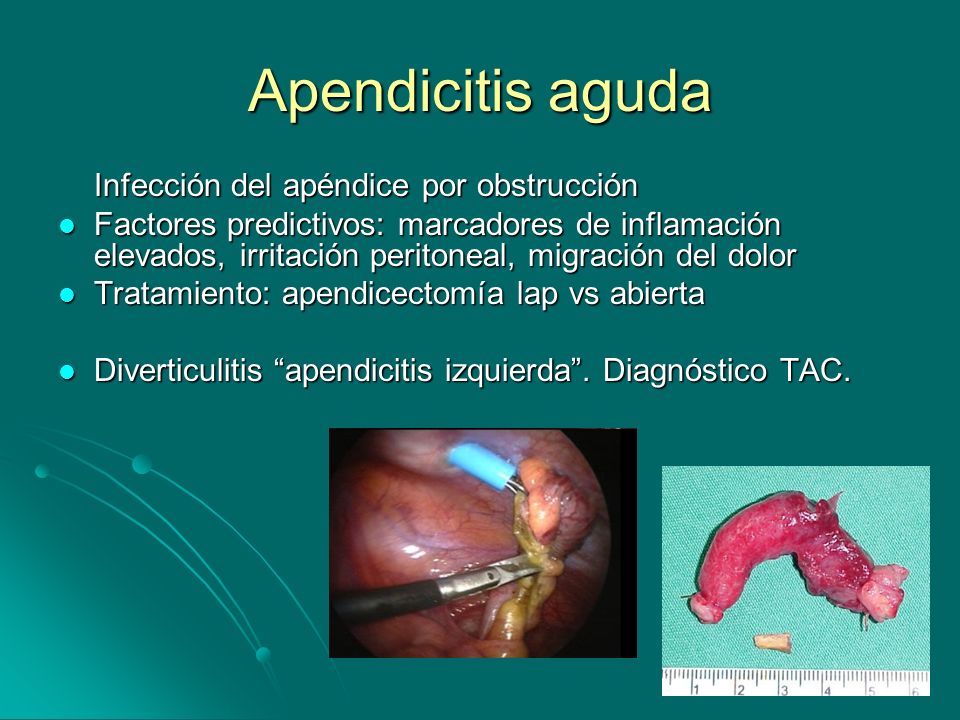 Apendicitis aguda Infección del apéndice por obstrucción