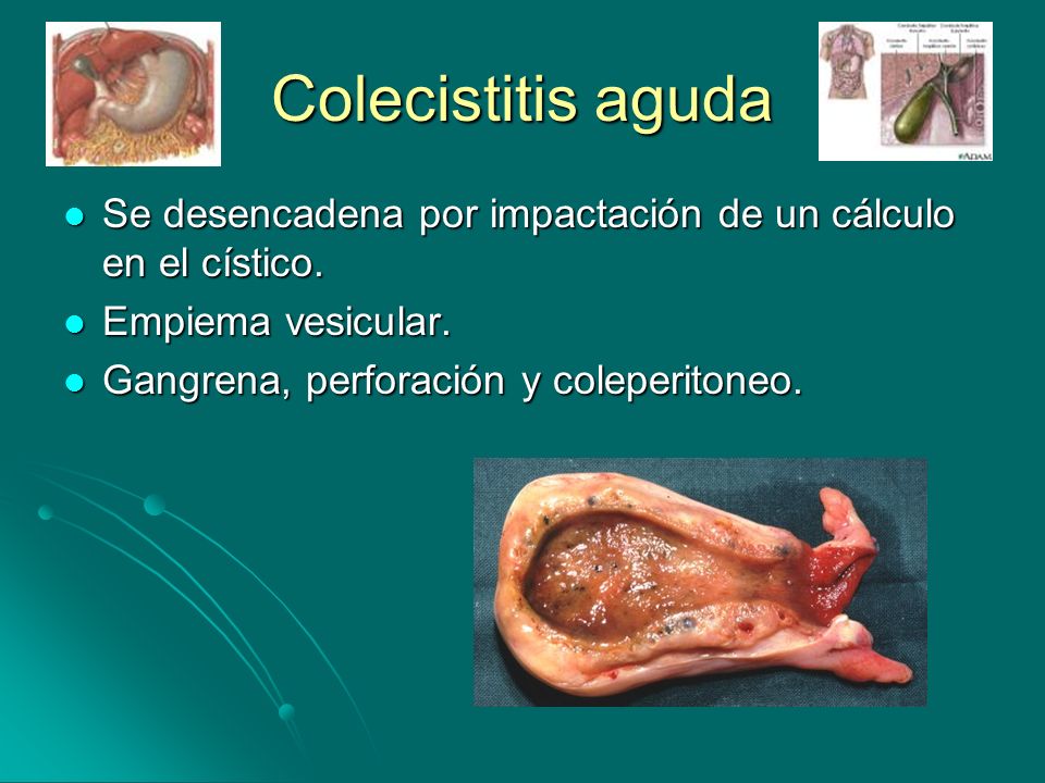 Colecistitis aguda Se desencadena por impactación de un cálculo en el cístico.