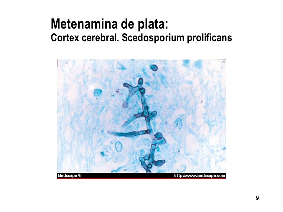 Metenamina de plata: Cortex cerebral. Scedosporium prolificans
