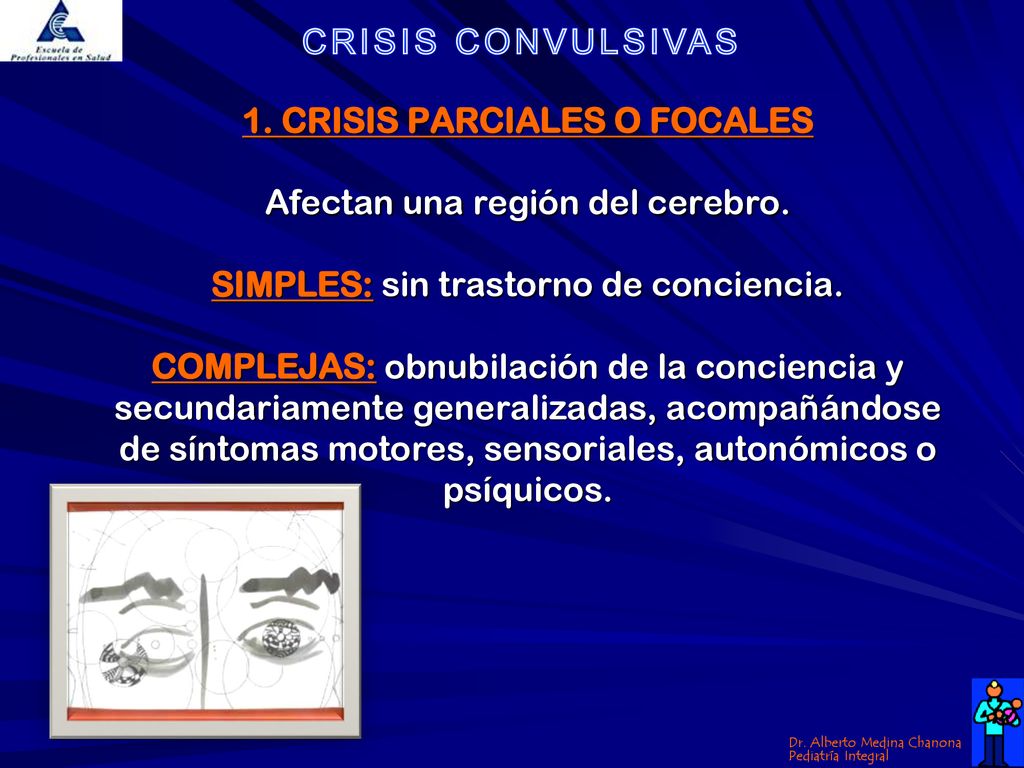 1. CRISIS PARCIALES O FOCALES Afectan una región del cerebro