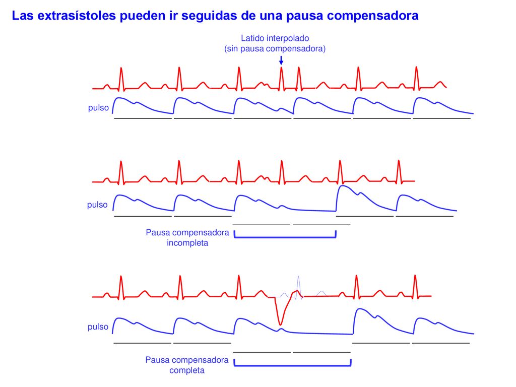 Las extrasístoles pueden ir seguidas de una pausa compensadora