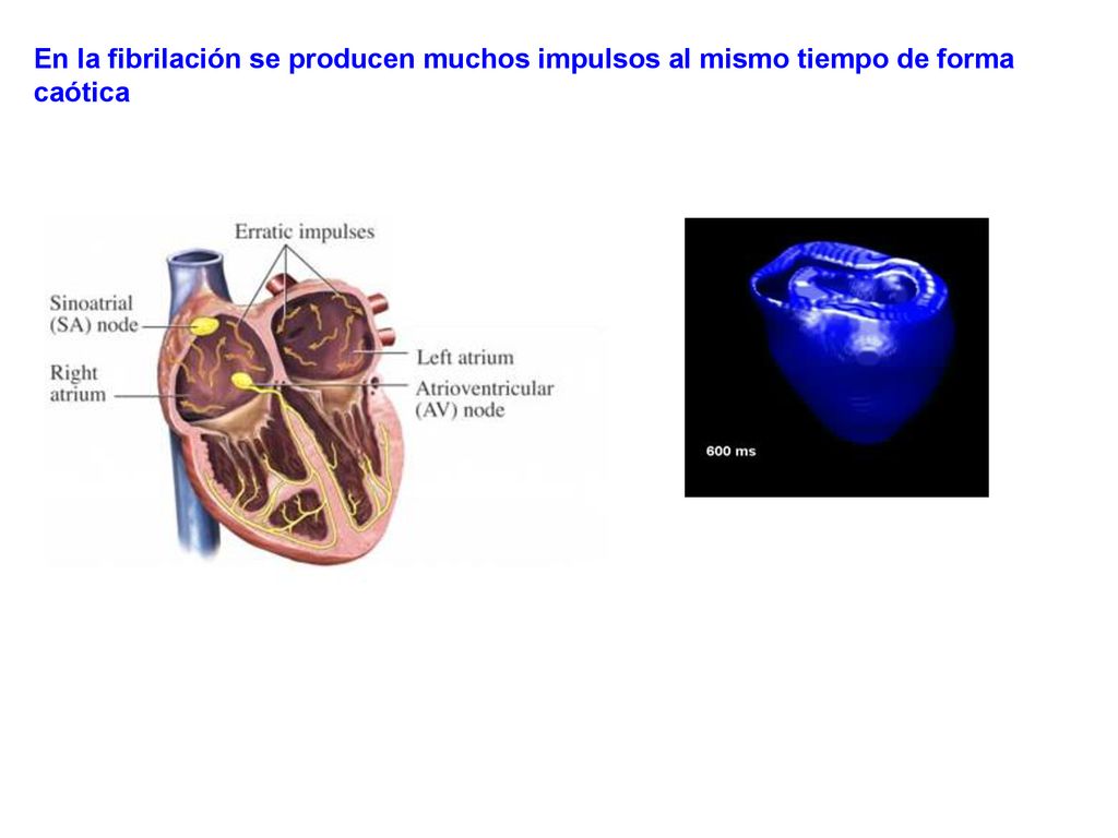En la fibrilación se producen muchos impulsos al mismo tiempo de forma caótica