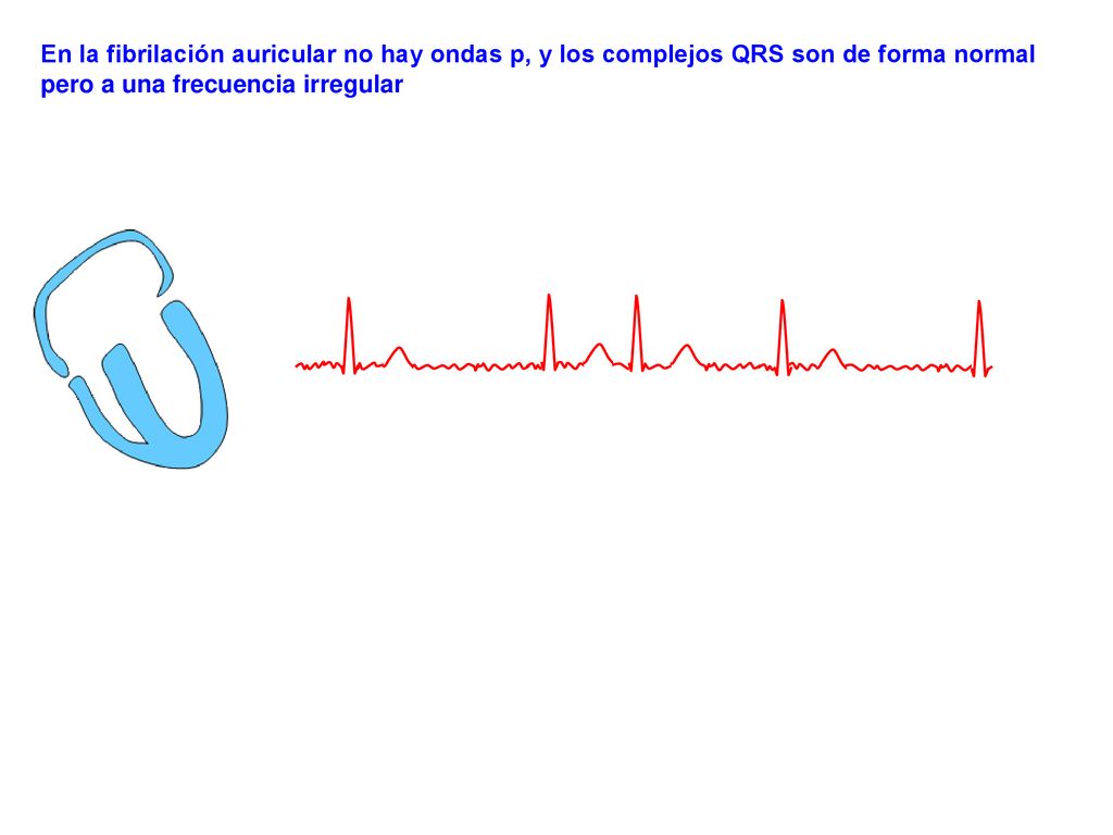 En la fibrilación auricular no hay ondas p, y los complejos QRS son de forma normal pero a una frecuencia irregular