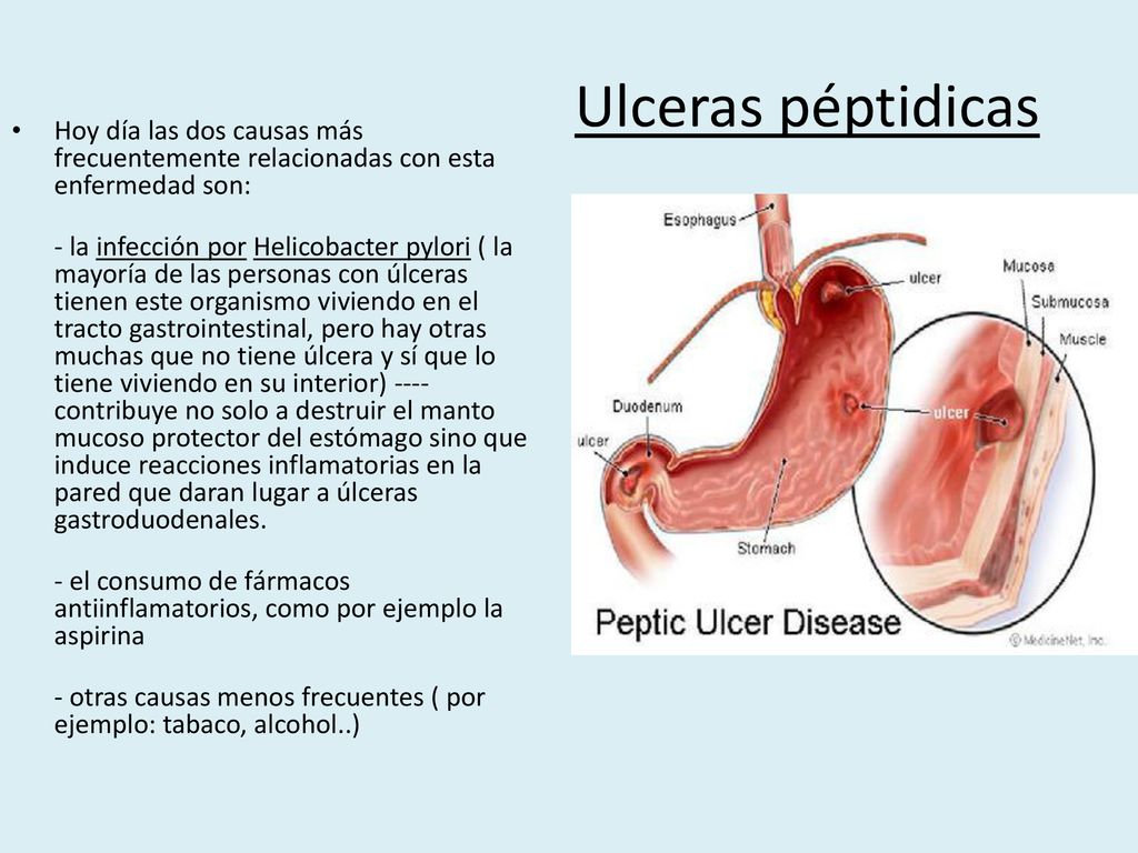 Ulceras péptidicas Hoy día las dos causas más frecuentemente relacionadas con esta enfermedad son: