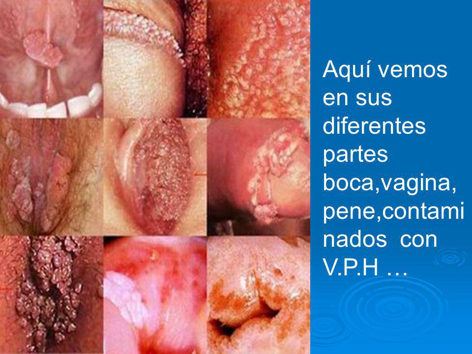 Aquí vemos en sus diferentes partes boca,vagina,pene,contaminados con V.P.H …
