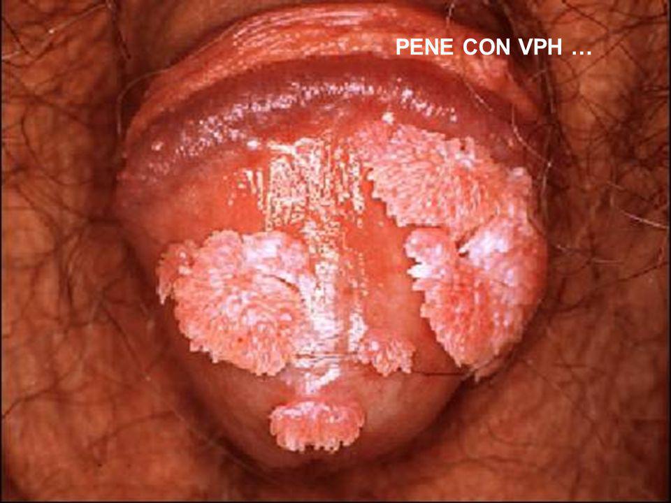 PENE CON VPH …