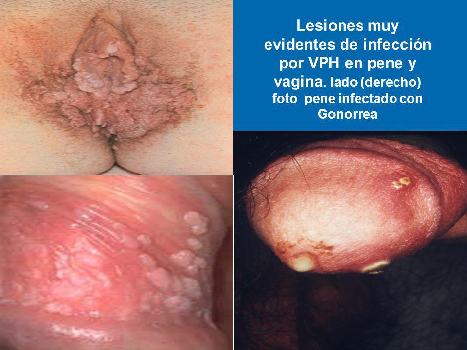 Lesiones muy evidentes de infección por VPH en pene y vagina