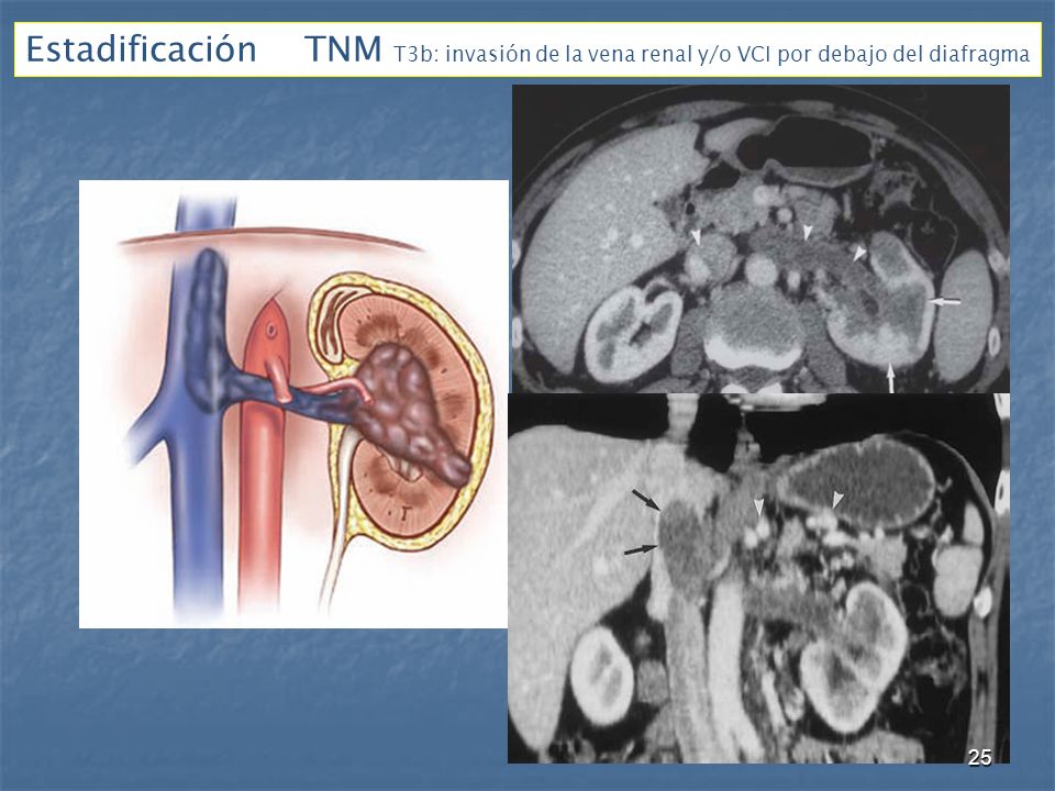 Estadificación TNM T3b: invasión de la vena renal y/o VCI por debajo del diafragma