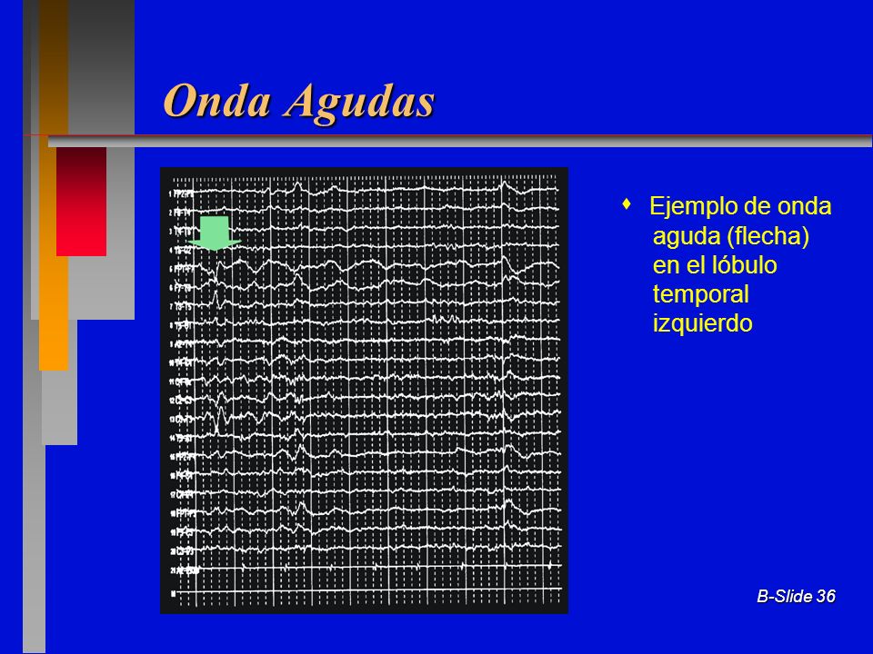 Onda Agudas  Ejemplo de onda aguda (flecha) en el lóbulo temporal izquierdo