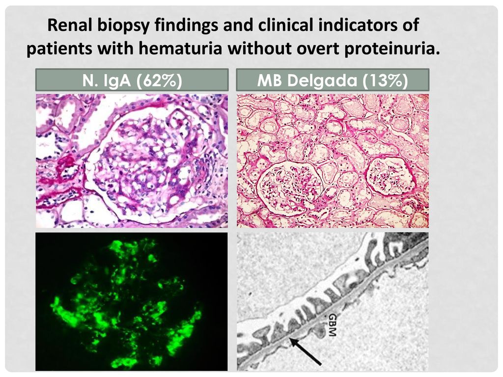Renal biopsy findings and clinical indicators of patients with hematuria without overt proteinuria.