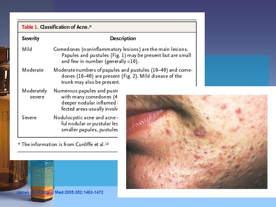 Mild Acne Figure 1. Mild Acne. Multiple open and closed comedones are present, with few inflammatory papules.