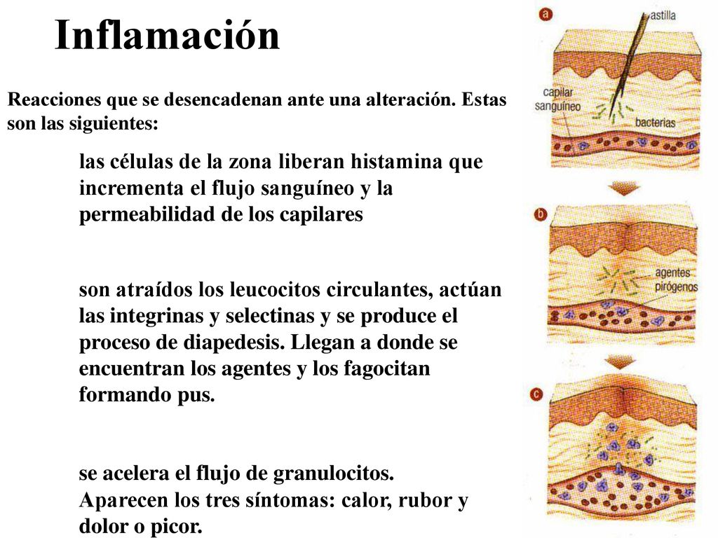 Inflamación Reacciones que se desencadenan ante una alteración. Estas son las siguientes: