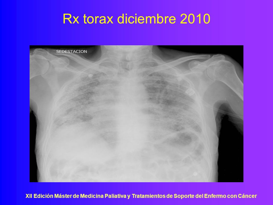 Rx torax diciembre 2010 XII Edición Máster de Medicina Paliativa y Tratamientos de Soporte del Enfermo con Cáncer.