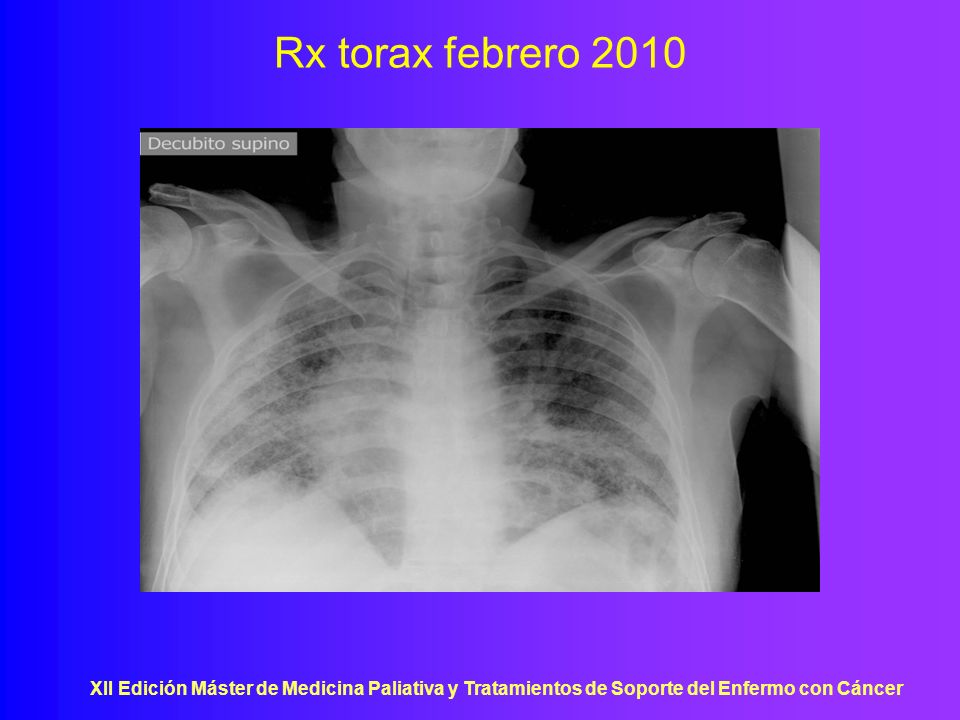 Rx torax febrero 2010 XII Edición Máster de Medicina Paliativa y Tratamientos de Soporte del Enfermo con Cáncer.
