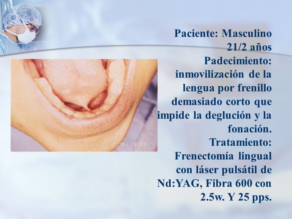 Paciente: Masculino 21/2 años Padecimiento: inmovilización de la lengua por frenillo demasiado corto que impide la deglución y la fonación.