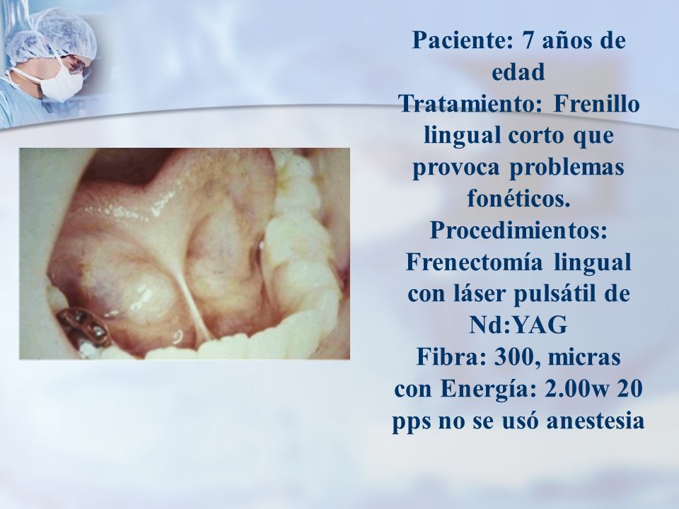 Paciente: 7 años de edad Tratamiento: Frenillo lingual corto que provoca problemas fonéticos.