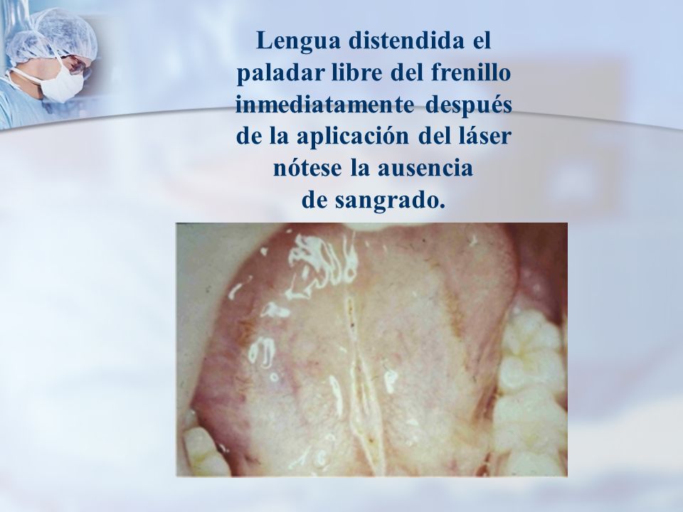 Lengua distendida el paladar libre del frenillo inmediatamente después de la aplicación del láser nótese la ausencia de sangrado.