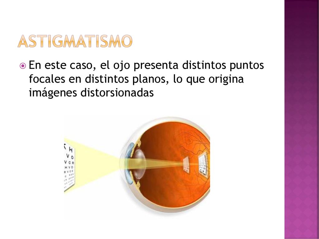 astigmatismo En este caso, el ojo presenta distintos puntos focales en distintos planos, lo que origina imágenes distorsionadas.