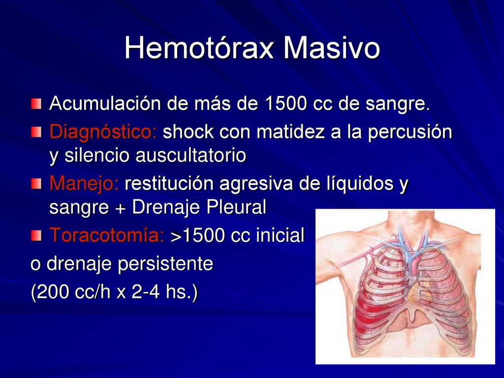 Hemotórax Masivo Acumulación de más de 1500 cc de sangre.