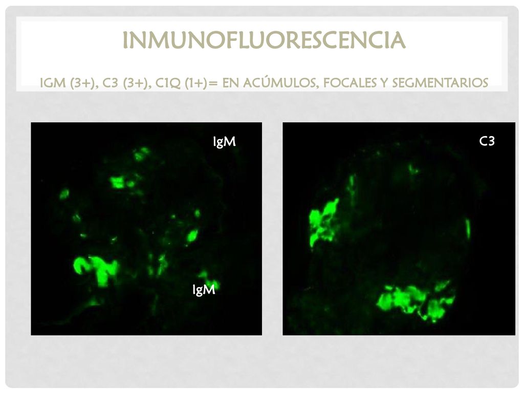 Inmunofluorescencia IgM (3+), C3 (3+), C1q (1+)= en acúmulos, focales y segmentarios