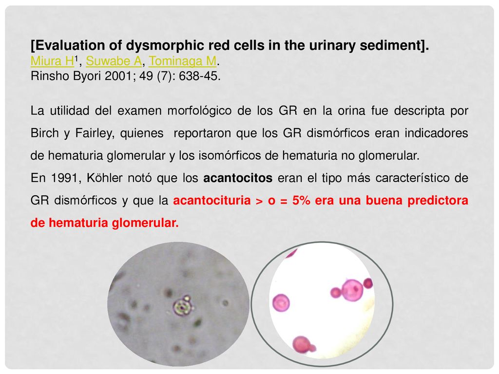 [Evaluation of dysmorphic red cells in the urinary sediment].