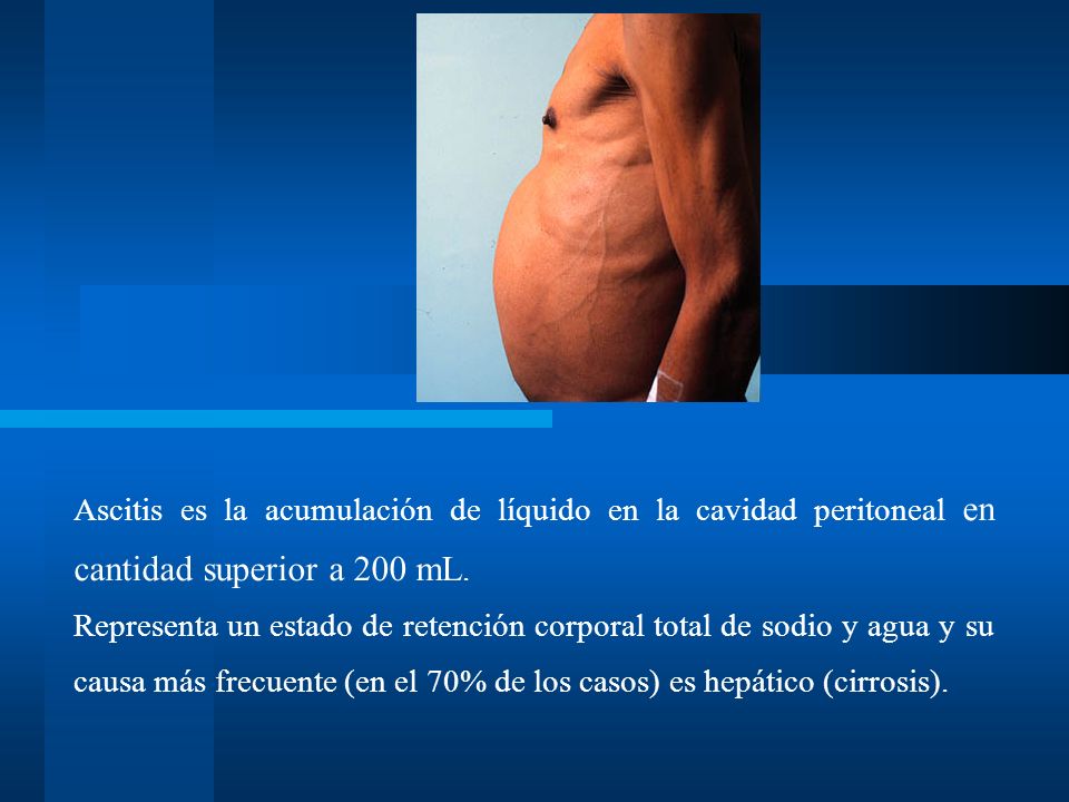 Ascitis es la acumulación de líquido en la cavidad peritoneal en cantidad superior a 200 mL.
