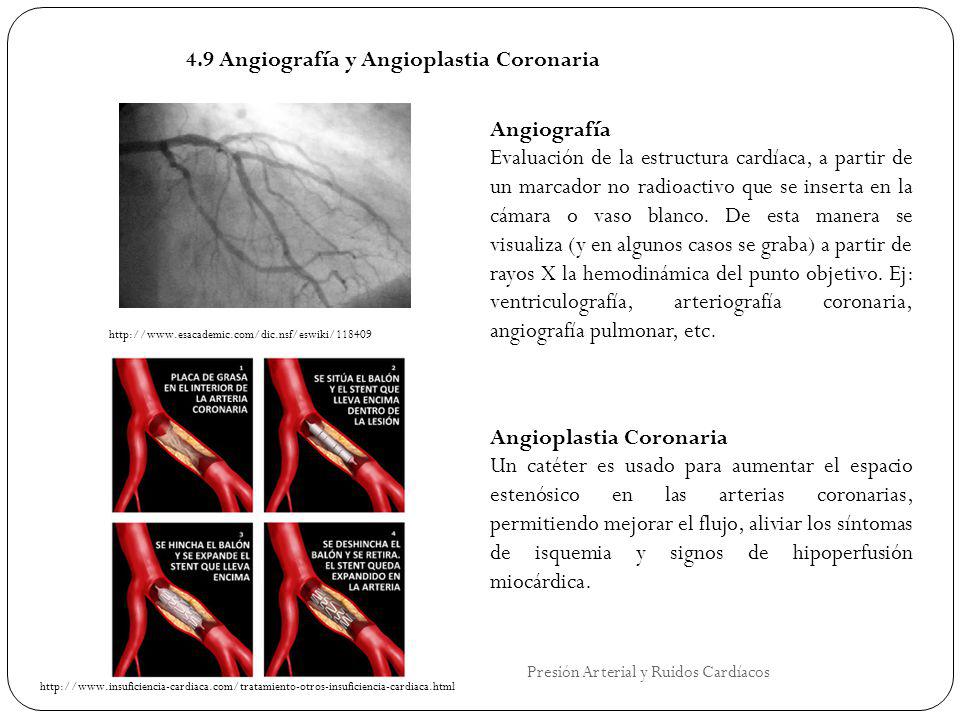 4.9 Angiografía y Angioplastia Coronaria
