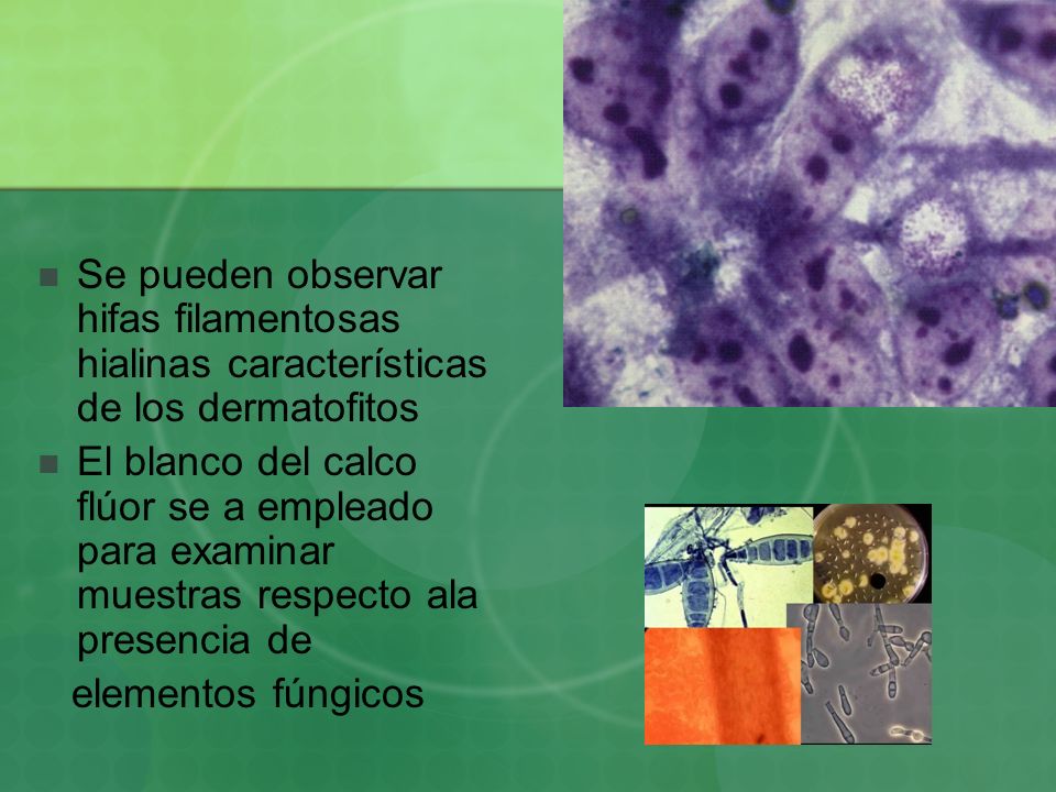 Se pueden observar hifas filamentosas hialinas características de los dermatofitos