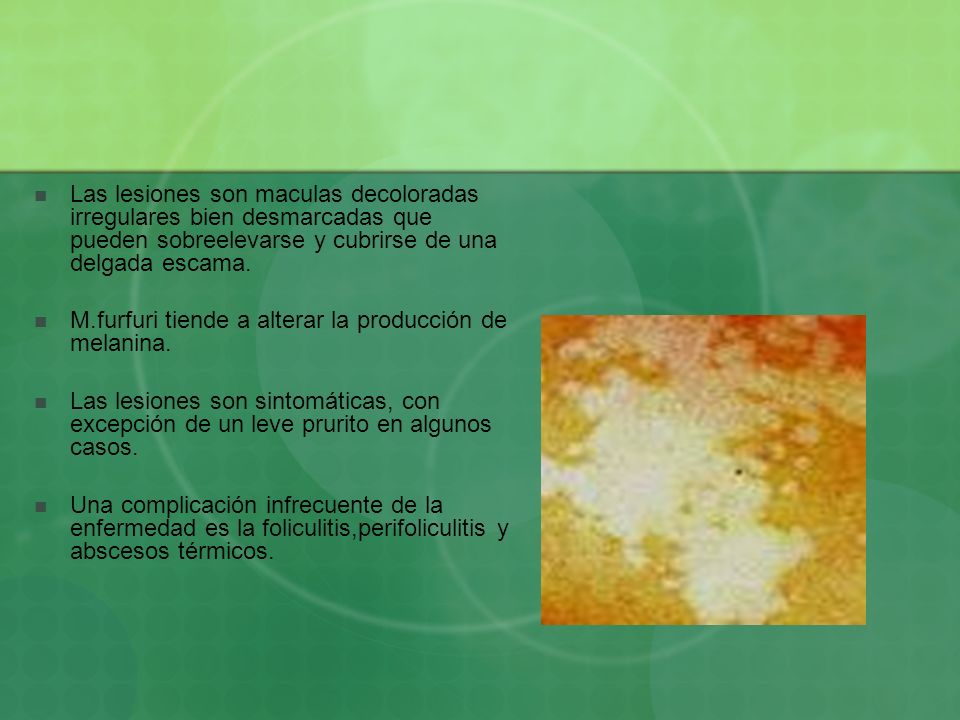 Las lesiones son maculas decoloradas irregulares bien desmarcadas que pueden sobreelevarse y cubrirse de una delgada escama.