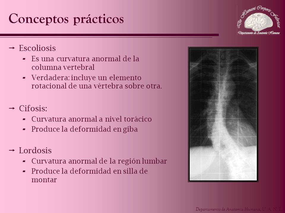 Conceptos prácticos Escoliosis Cifosis: Lordosis
