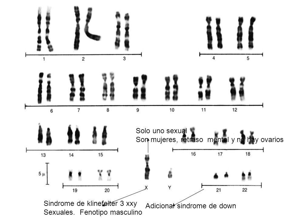 Solo uno sexual Son mujeres, retraso mental y no hay ovarios. Sindrome de klinefelter 3 xxy. Sexuales. Fenotipo masculino.