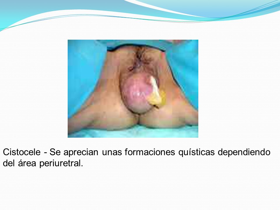 Cistocele - Se aprecian unas formaciones quísticas dependiendo del área periuretral.