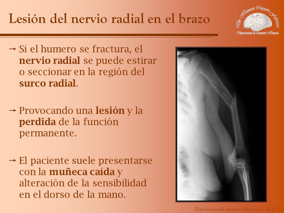 Lesión del nervio radial en el brazo