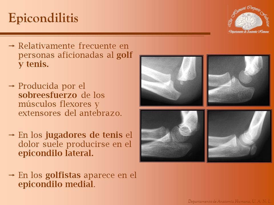 Epicondilitis Relativamente frecuente en personas aficionadas al golf y tenis.